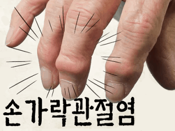 손가락 퇴행성 관절염 원인과 증상, 예방 방법